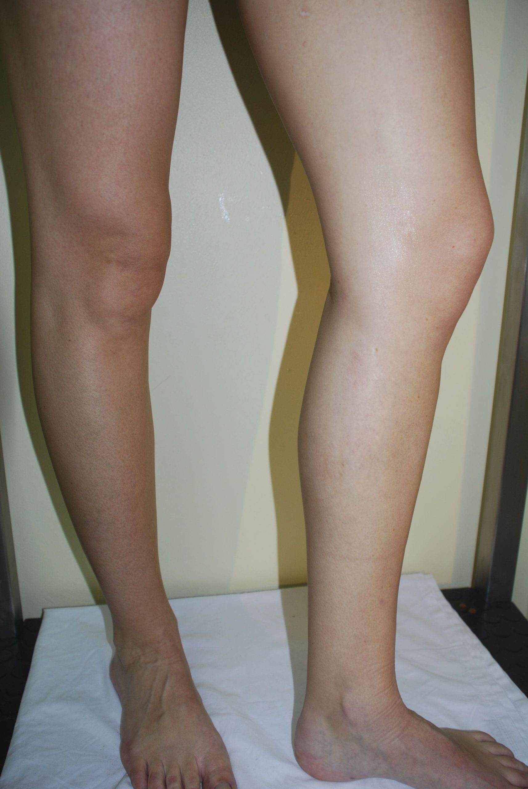 Doctor luis franco, Arañas vasculares en las piernas