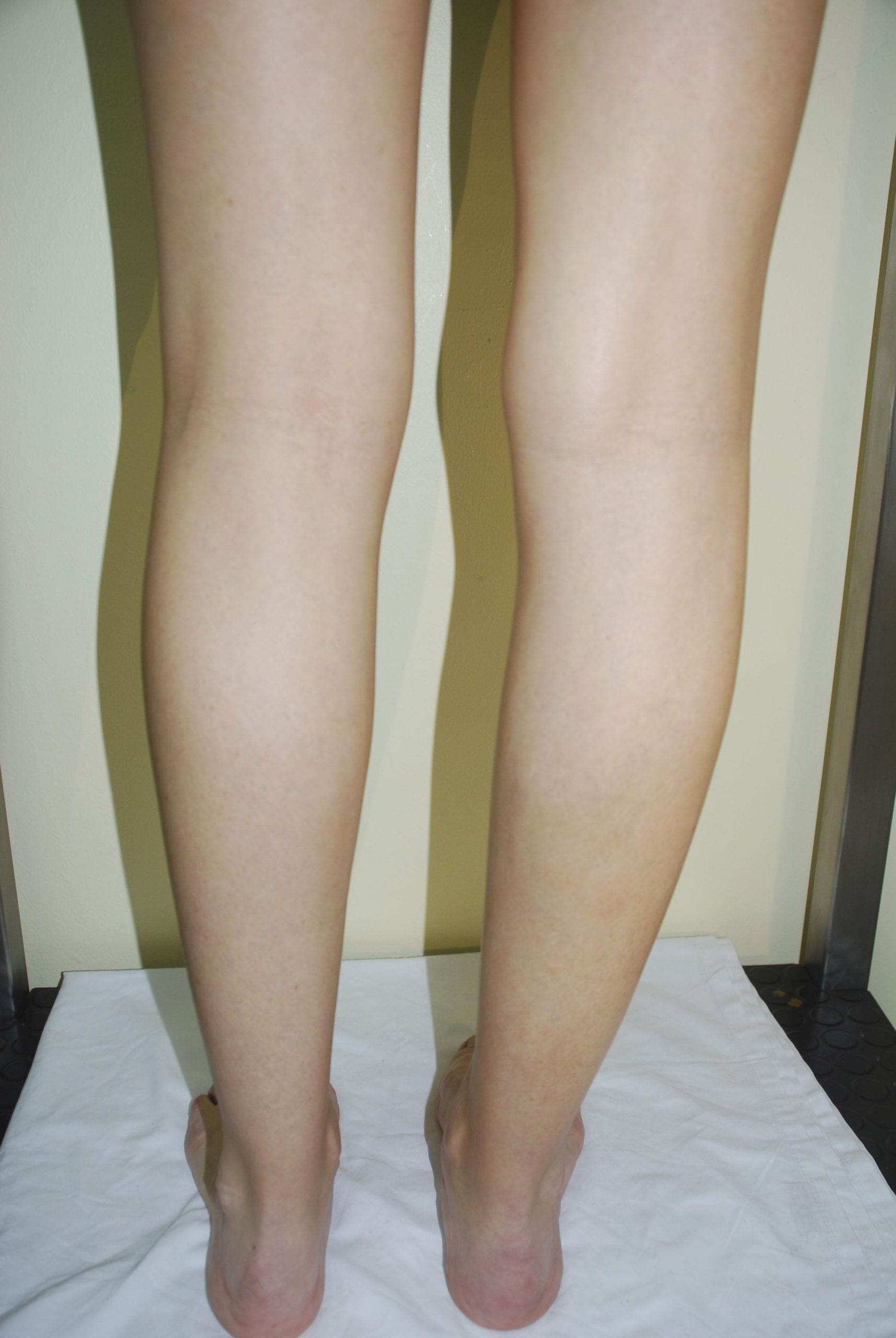 Doctor luis franco, Arañas vasculares en las piernas 2